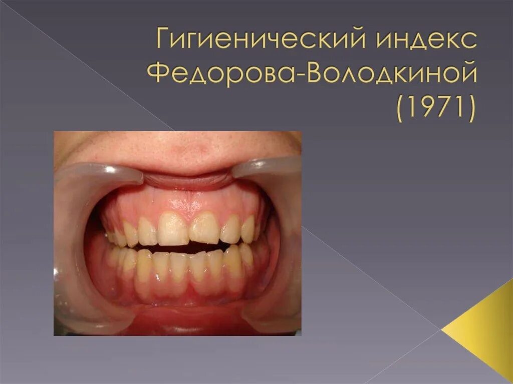 Индекс федора. Гигиенический индекс фёдорова-володкиной. гигиенический индекс федорова-володкиной (1971. гигиенический индекс полости рта федорова володкиной. индекс федорова володкиной.