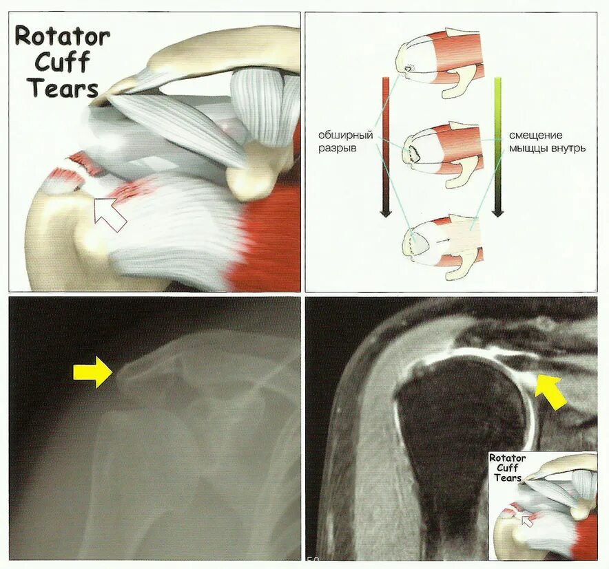 Ротаторная манжета плечевого сустава разрыв. Ротаторная манжета мрт. Разрыв ротаторной манжеты на мрт. Роторная манжета плеча повреждение. Разрыв плечевого сустава симптомы