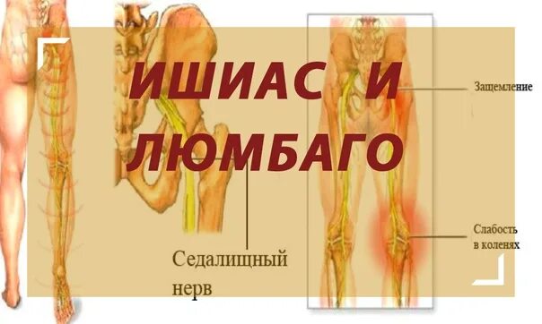 Симптомы боли седалищного нерва у мужчин. Схема защемления седалищного нерва. Люмбаго с ишиасом. Ишиас седалищного нерва. Седалищный нерв расположение в организме.