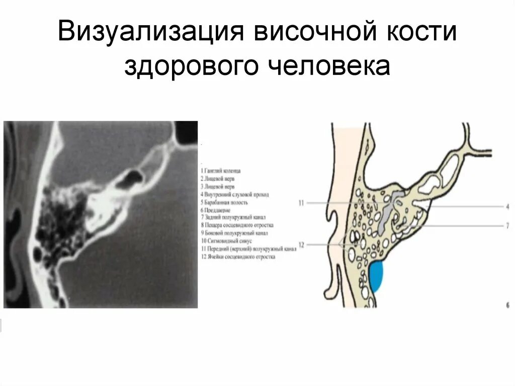 Утолщение слизистой сосцевидного отростка. Анатомия ячеек сосцевидного отростка на кт. Ячейки сосцевидного отростка височной кости. Антрум височная кость кт. Рентген сосцевидного отростка височной кости.