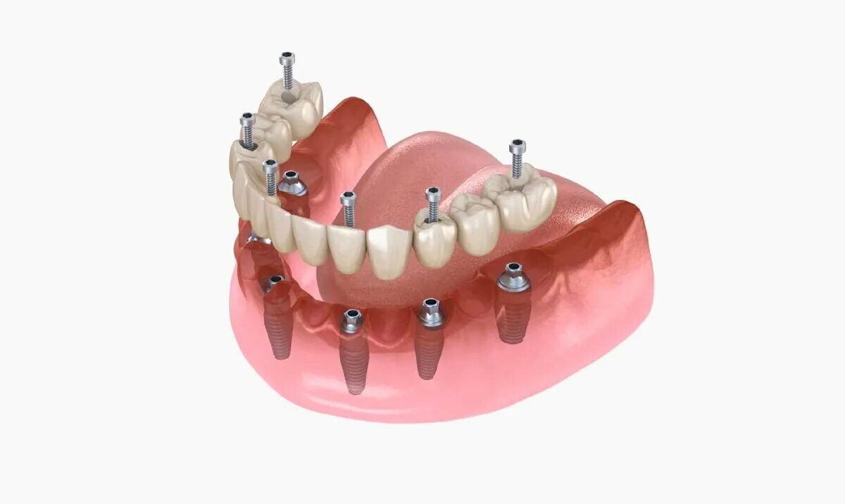Имплантация зубов на 6 имплантах верхней челюсти. Имплантация верхней челюсти на 4 имплантах. Несъемный мостовидный протез с опорой на 4 имплантата. Имплантация челюсти на 4 имплантах.