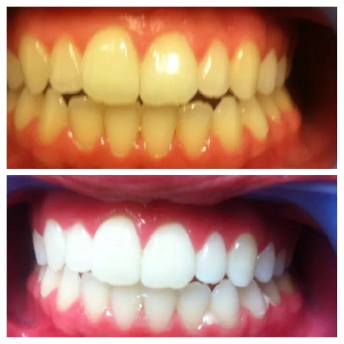 Отбеливание зубов. Отбеливание зубов до и после. Отбеливание зубов маслами