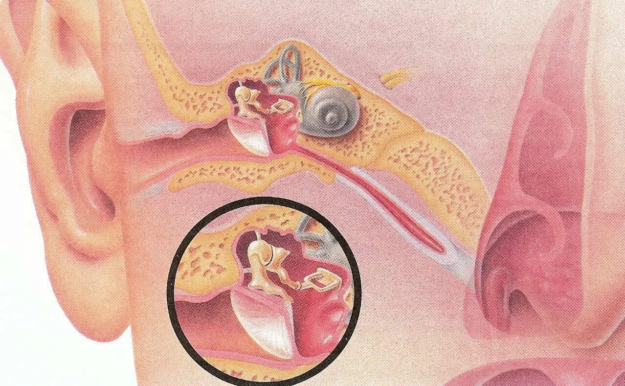 Заложило ухо после орви. Евстахиева труба и носоглотка. Отомикоз серная пробка.