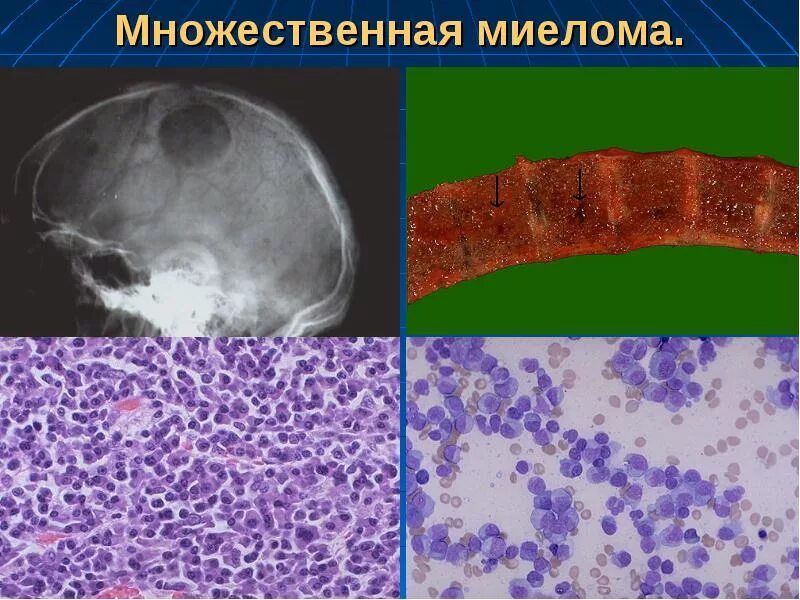 Миеломная болезнь что. Миеломная болезнь патоморфология. Множественная миелома препарат гистология. Множественная миелома макропрепарат. Миеломная болезнь костный мозг гистология.