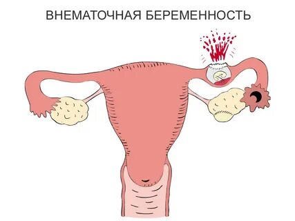 Внематочная беременность операция сколько