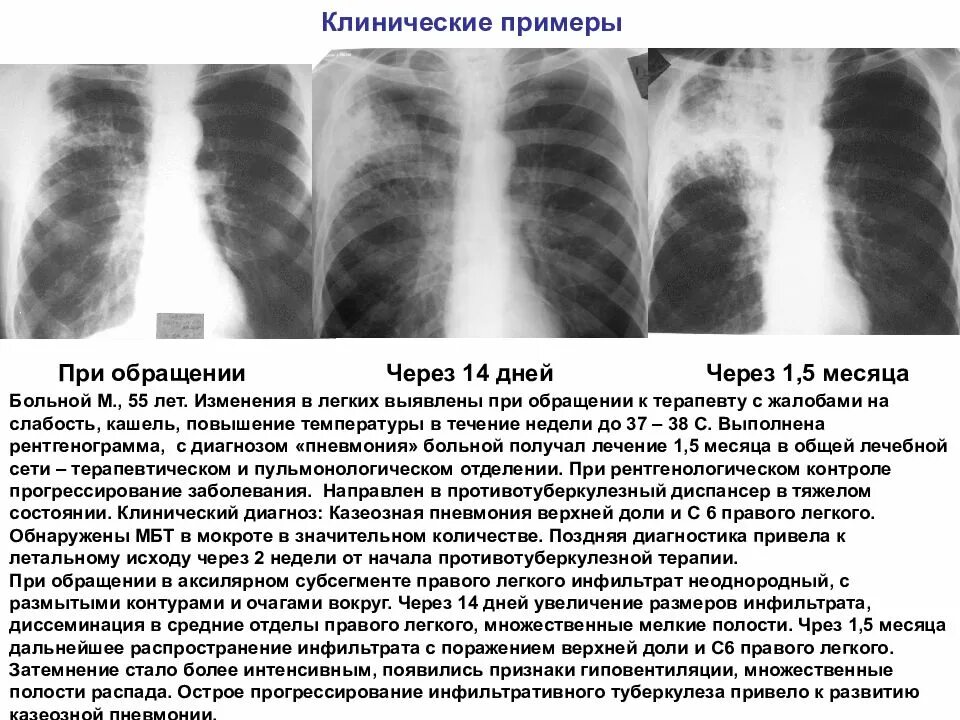 Туберкулез легких в фазе инфильтрации. Инфильтративный туберкулез Лобит рентген. Очагово-инфильтративный туберкулез рентген. Очаговый туберкулез верхней доли правого легкого в фазе инфильтрации. Описание рентгенограммы инфильтративного туберкулеза.