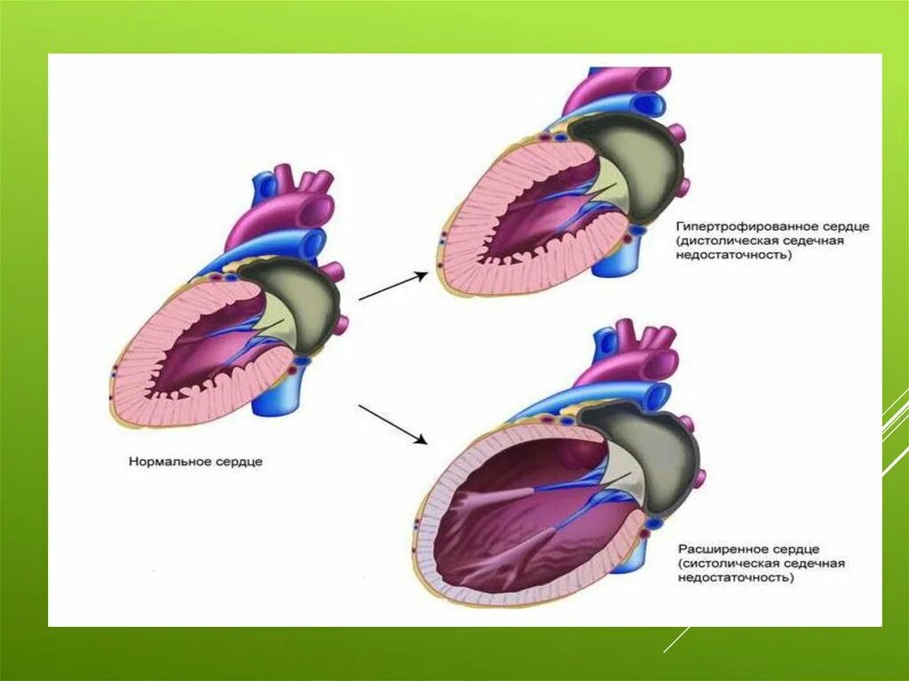 Дисфункции желудочков сердца. Типы ремоделирования миокарда левого желудочка. Систолическая недостаточность левого желудочка. Гипертрофированное сердце.