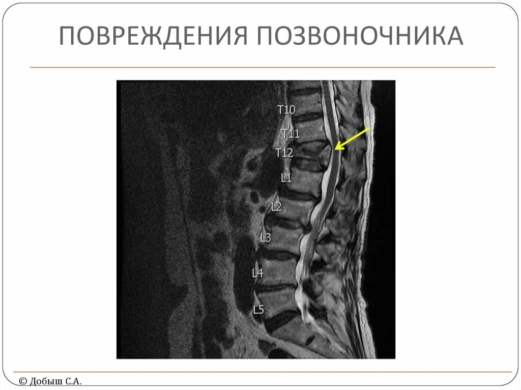 Травма поясничного отдела позвоночника