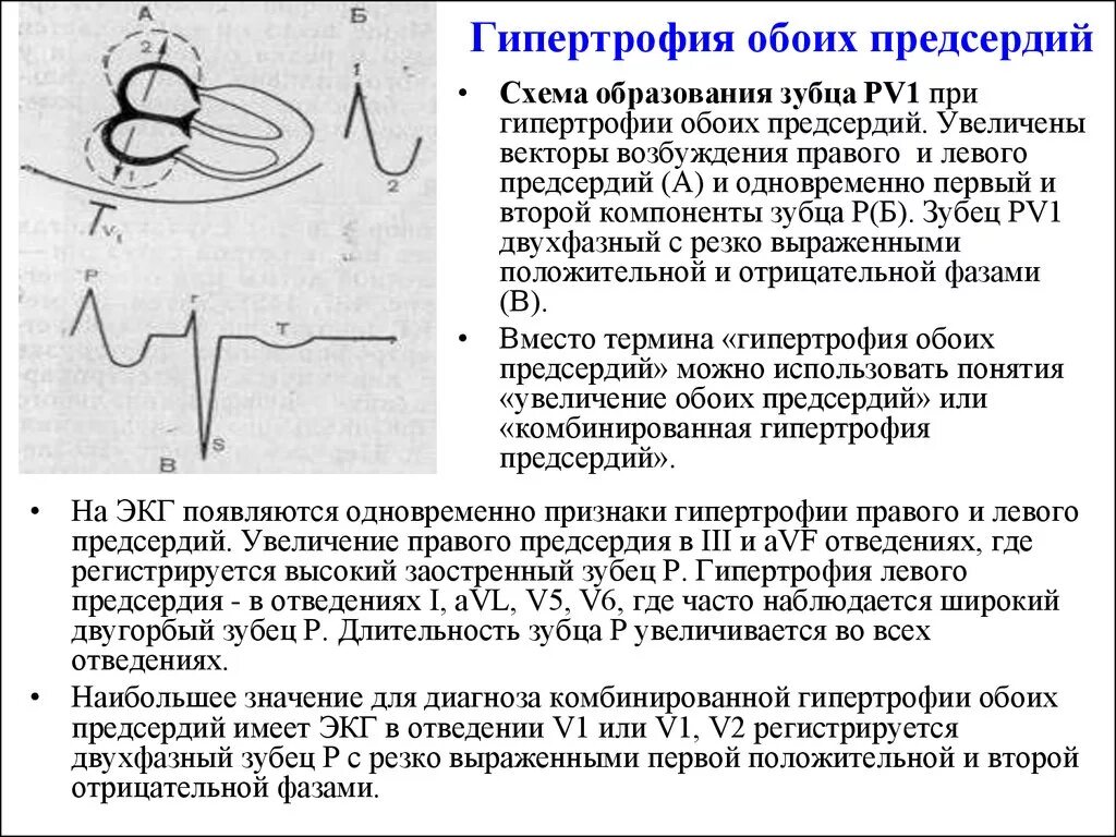 Гипертрофия что это. Критерии гипертрофии левого предсердия на ЭКГ. ЭКГ признаки гипертрофии миокарда левого предсердия. Гипертрофия правого предсердия ЭКГ зубец р. ЭКГ зубец р при гипертрофии левого предсердия.