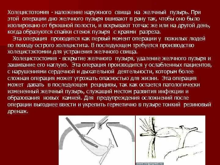 Лапароскопическая холецистостомия ход операции. Оперирование желчного пузыря. Холецистостомия желчного пузыря операция. Операция правильно написано