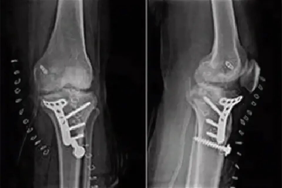 Остеосинтез перелома берцовой кости. Перелом мыщелка остеосинтез. Остеосинтез переломов мыщелков большеберцовой кости. Остеосинтез при переломе мыщелков большеберцовой кости.