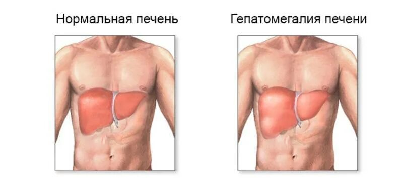 Гепатоспленомегалия селезенки. Увеличенная печень и селезенка.