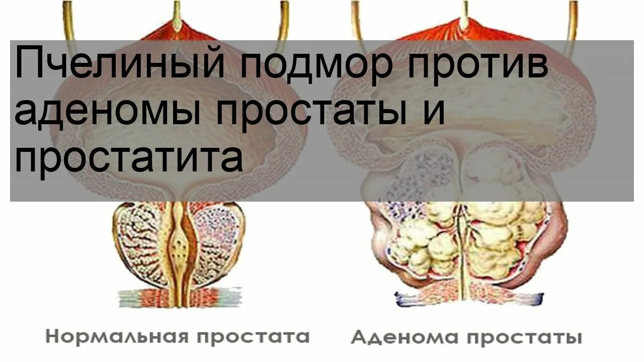 Простат аденом отзывы. Простатит vs аденома. пчелиный подмор от простатита. пчелиный подмор при аденоме простаты.