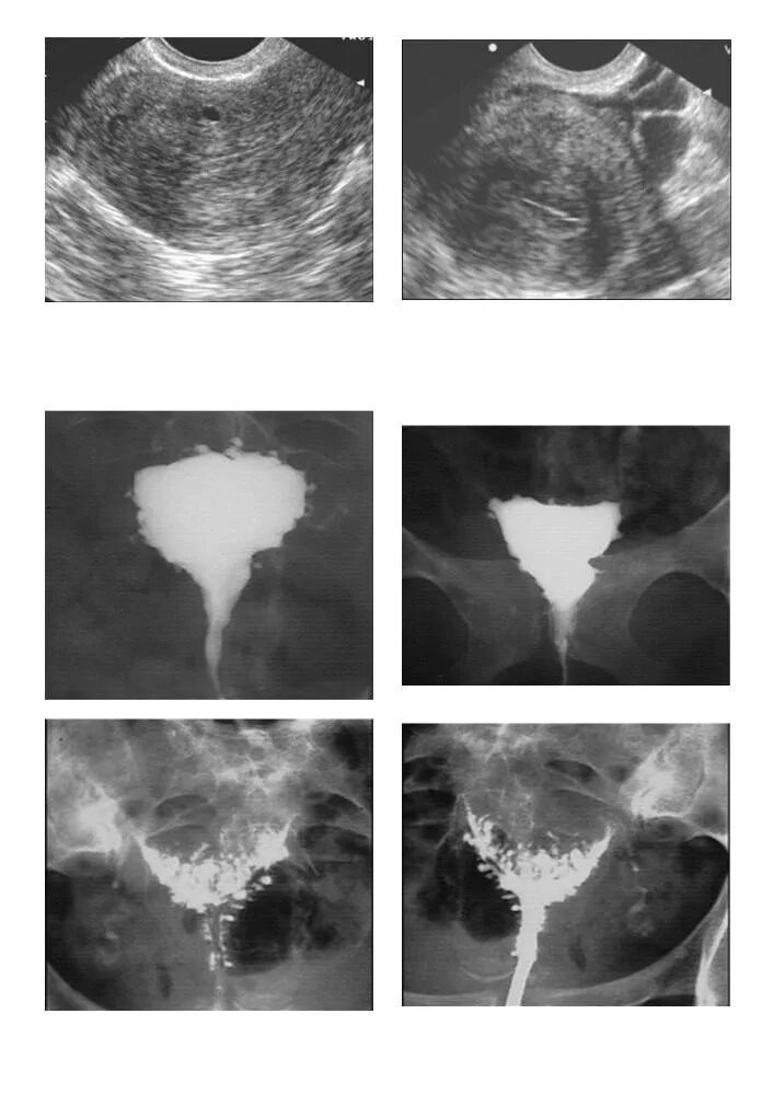 эндометриоз фаллопиевых труб. киста матки симптомы и признаки у женщин. доброкачественные опухоли яичников узи. ретенционное образование яичника узи. эндометриоидная киста яичника на узи протокол.