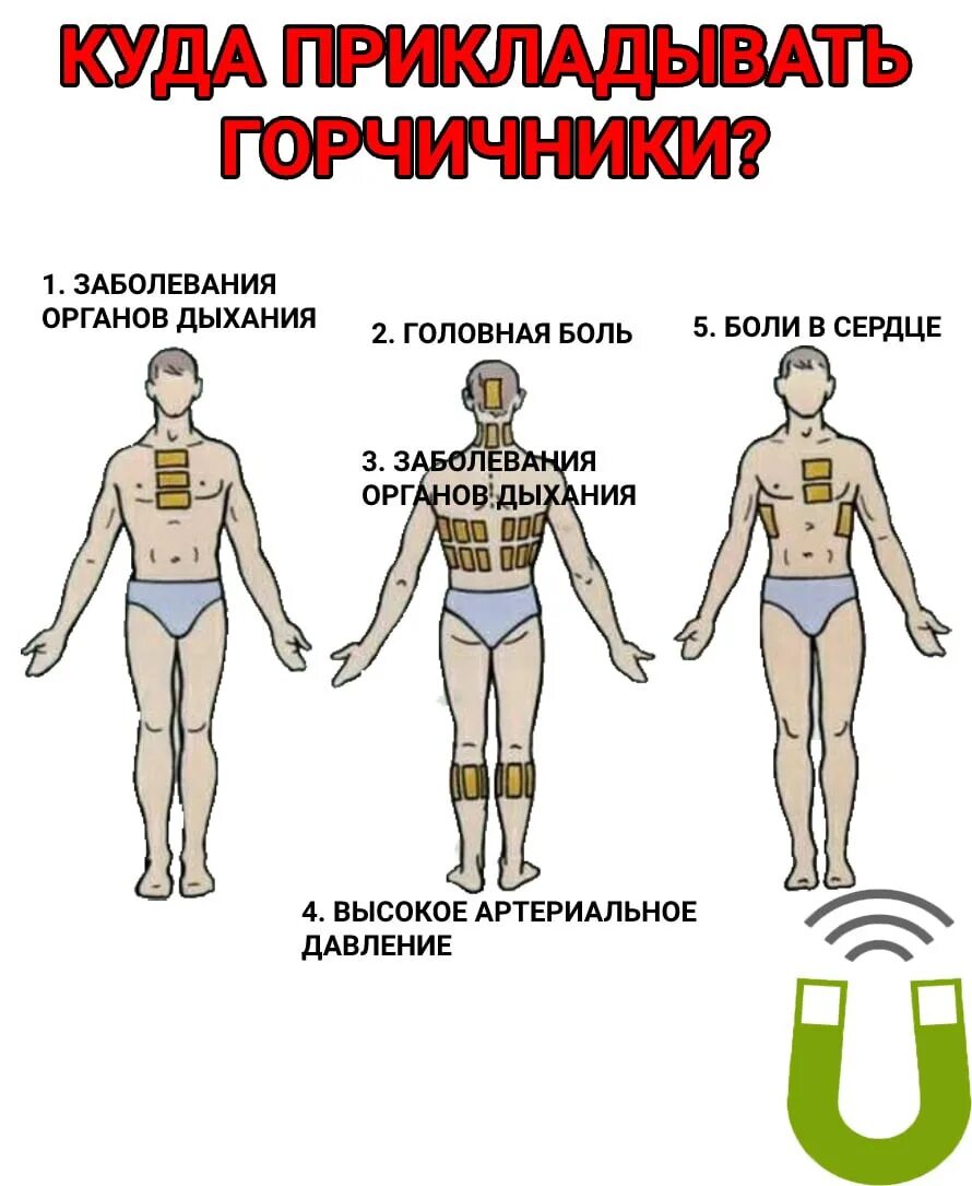 Можно ли ставить горчичники при кашле взрослому. Куда ставить горчичники. Куда прикладывать горчичники. Куда ставить горчичники при кашле. Аудас ставить горчичники.