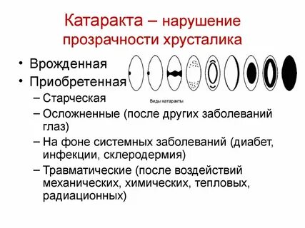 Симптомы катаракты после 60