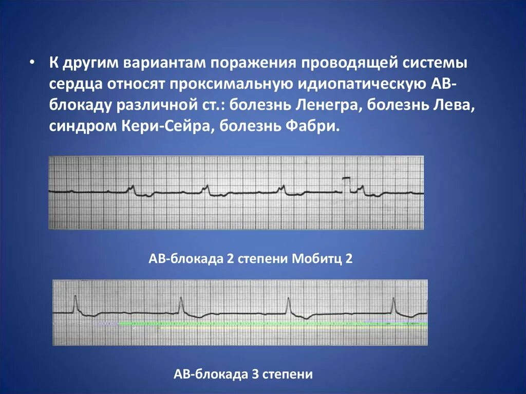 Болезни на экг. Болезнь Ленегра на ЭКГ. Болезнь Лева-Ленегра ЭКГ. Мерцательная аритмия с полной АВ блокадой. Проксимальная и дистальная АВ блокада.