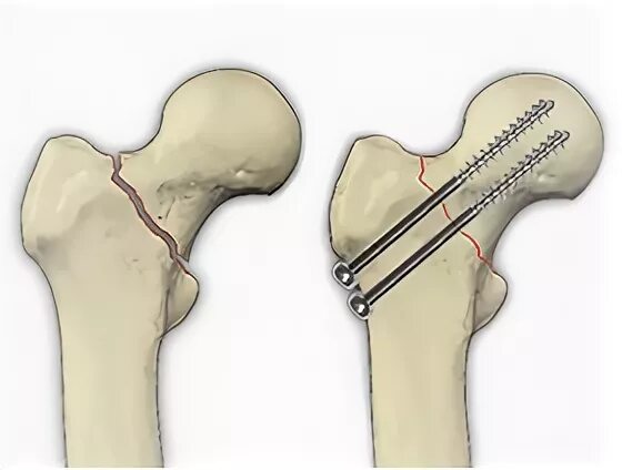 Перелом шейки бедра остеосинтез. Канюлированные винты для шейки бедра. Фиксатор при переломе шейки бедра. Перелом головки бедренной кости.