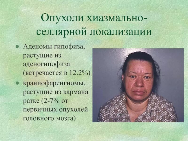 Гипофиза симптомы у женщин лечение прогноз. Опухоль гипофиза симптомы. опухоль гипофиза у женщин. опухоль гипофиза симптомы у женщин. аденома гипофиза симптомы.