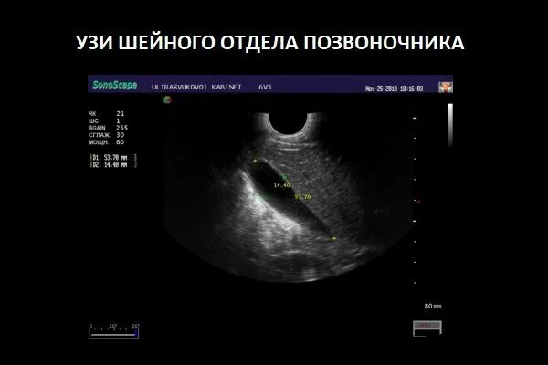 Узи позвоночника. Протокол узи позвоночника. Ультразвуковое исследование шейного отдела позвоночника у детей. Узи шейного отдела позвоночника ребенку. Узи шейного отдела позвоночника у детей.