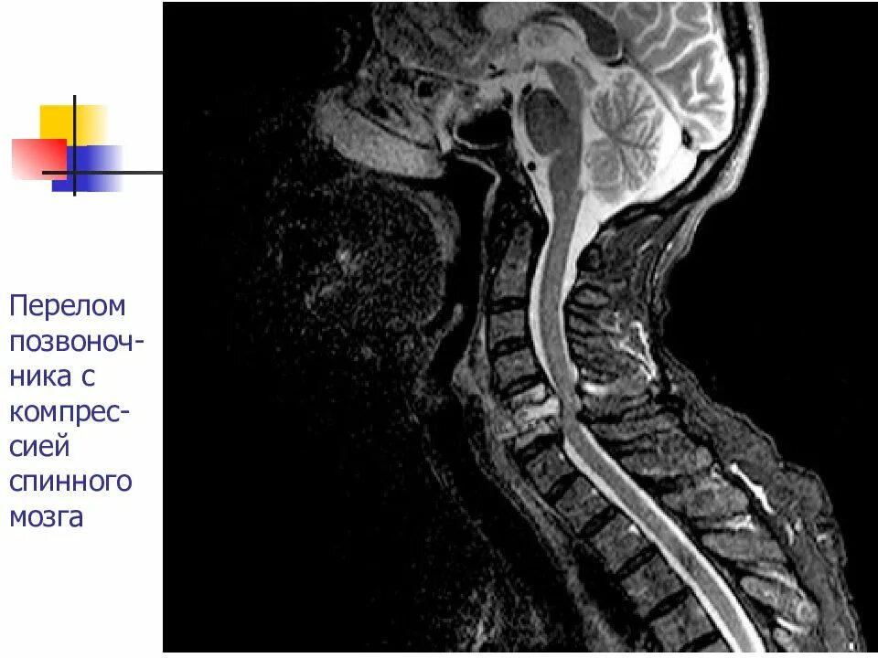 Боль в спинном мозге. Миелопатия шейного отдела позвоночника мрт. Миелопатия спинного мозга мрт. Компрессионная миелопатия шейного отдела. Миелопатия шейного отдела спинного мозга.