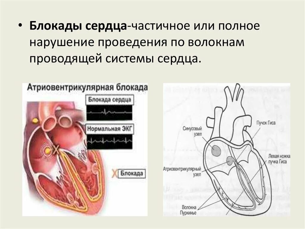 Системами блокада. Блокада проводящей системы сердца ЭКГ. Сердечно сосудистая система. Лекарства влияющие на сердечно сосудистую систему. Сердечные блокады.