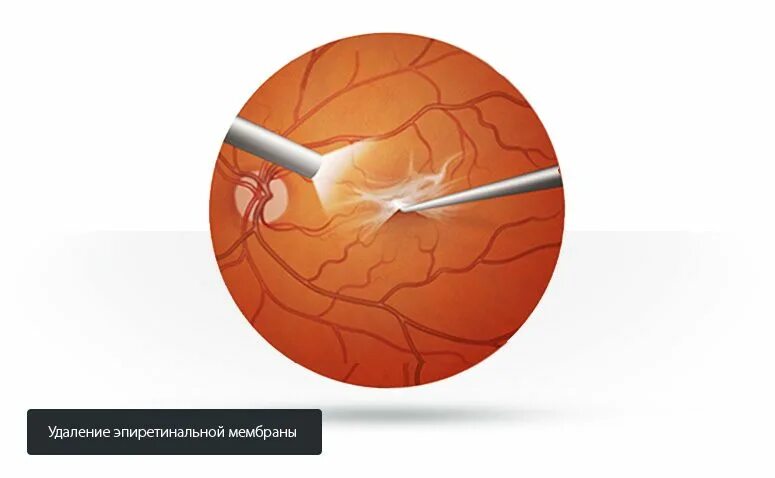 Эпиретинальный фиброз глаза. Эпиретинальная мембрана сетчатки. Эпиретинальная мембрана операция. Эпиретинальная мембрана (целлофановая макула).