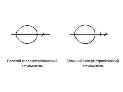 Астигматизм на 1 глазу