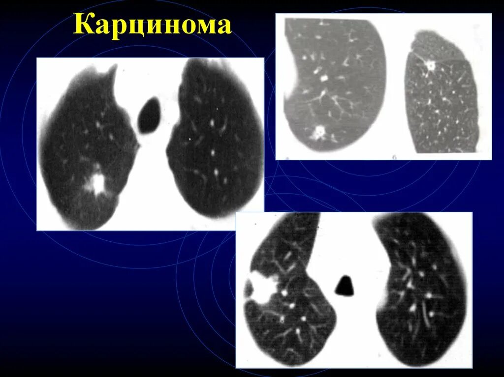 Образования в легких человека