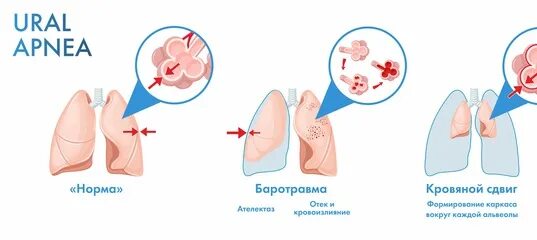 Спонтанный пневмоторакс рентгенограмма. Травмы органов грудной полости. Пневматорокса. Пневмоторакс хирургия. Правосторонний пневмоторакс рентген.