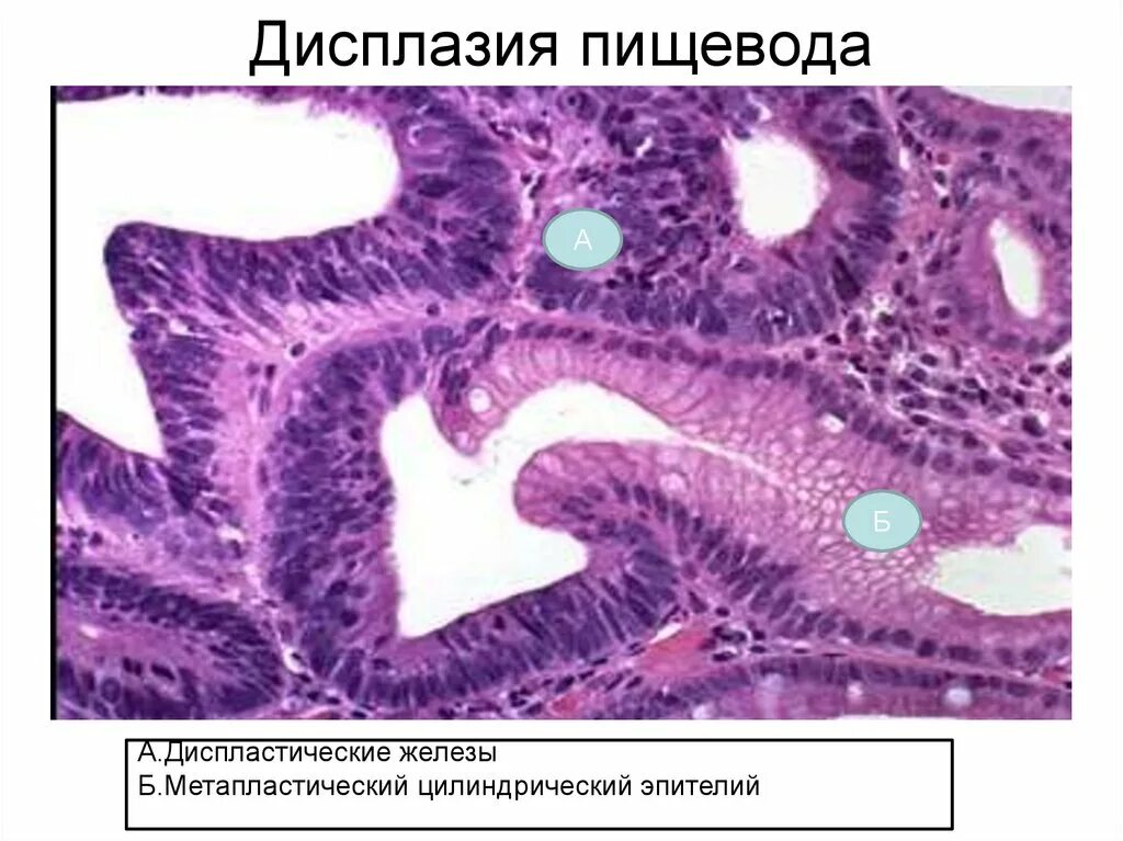 Толстокишечная метаплазия гистология. Пищевод Барретта метаплазия эпителия. Дисплазия эпителия гистология. Дисплазия слизистой желудка гистология.