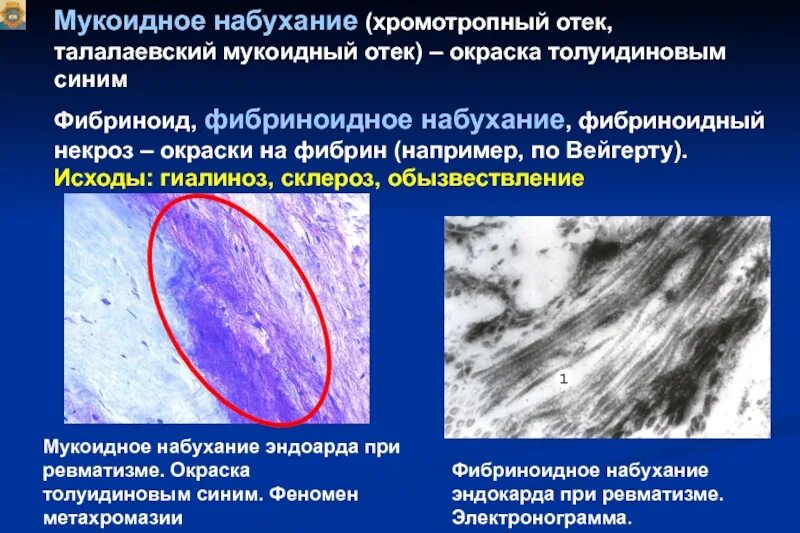 Без перифокальной реакции. Фибриноидное набухание микроскопия. Мукоидное набухание феномен метахромазии. Мукоидное набухание фибриноидное набухание гиалиноз и амилоидоз. Мукоидное набухание макроскопическая картина.