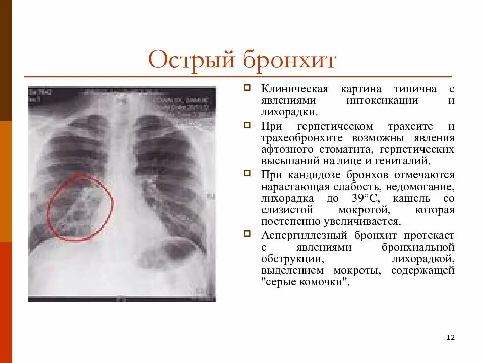 Очаговый бронхит. Острый бронхит рентген описание. Рентгенография органов грудной клетки при остром бронхите. Рентген при остром обструктивном бронхите у детей описание. Рентген при остром нхите.