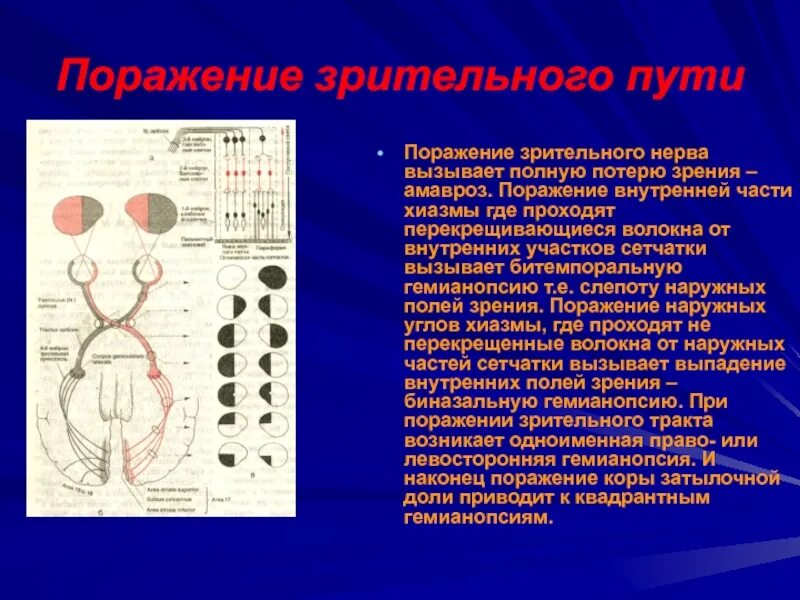 Размеры зрительных нервов. Поражение зрительного нерва. Гемианопсия возникает при поражении. При поражении хиазмы зрительного нерва возникает. При поражении зрительного тракта возникает гемианопсия.