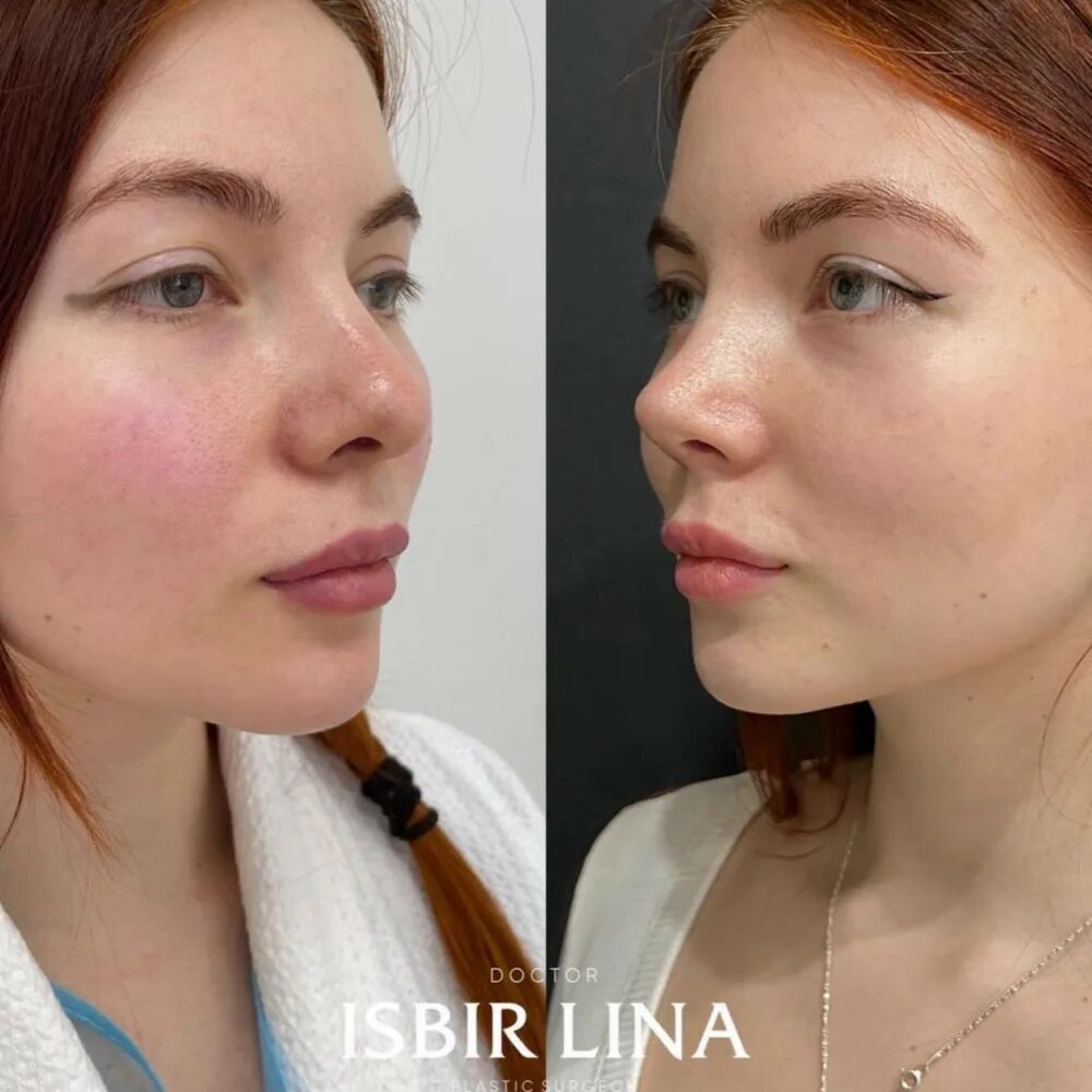 Ринопластика носа картошкой. Нос картошкой ринопластика до и после. Пластика широкого носа. Пластическая операция нос картошкой. Почему нос картошкой.