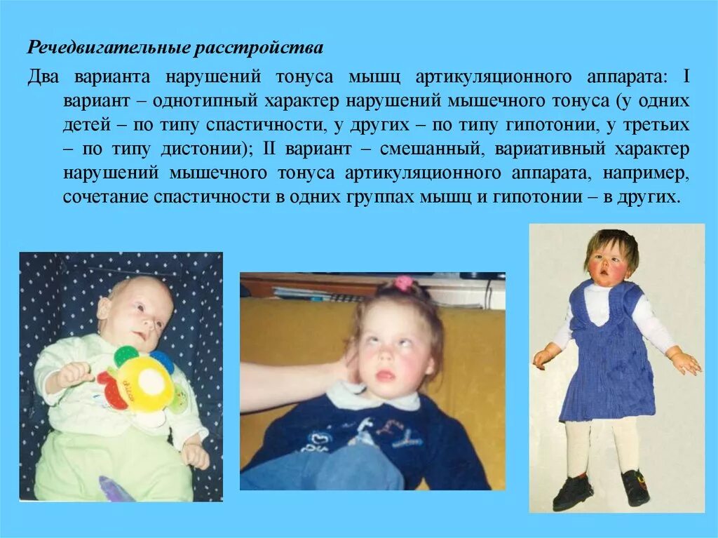 Мышечная дистония код