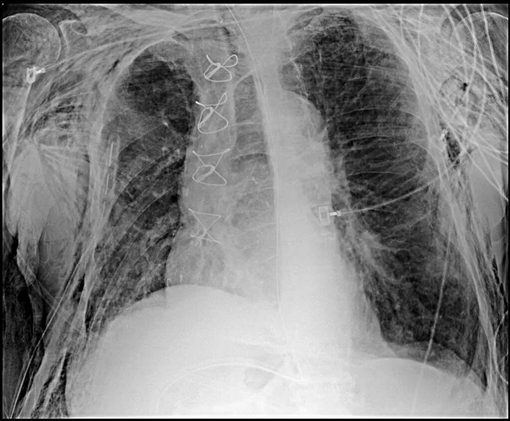 Подкожная эмфизема рентген. Танталовый шов на легком рентген. Танталовые скобы рентген. Танталовые швы на рентгене.