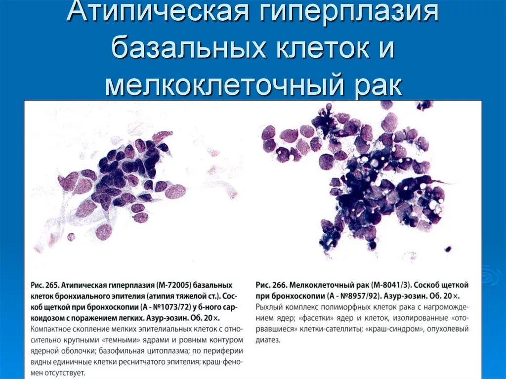 Пролиферация гиперплазия цитология. Цитологическая картина гиперплазии железистого эпителия. Метаплазия эпителия шейки матки цитология. Эпидермальная гиперплазия. Гиперплазированные лимфоузлы