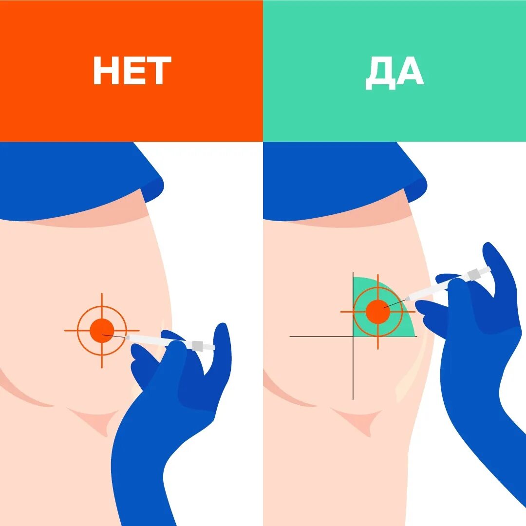 Как не больно сделать укол в ягодицу. Как делать укол. Куда делать укол внутримышечно. Укол в ягодицу схема. Как колоть уколы.