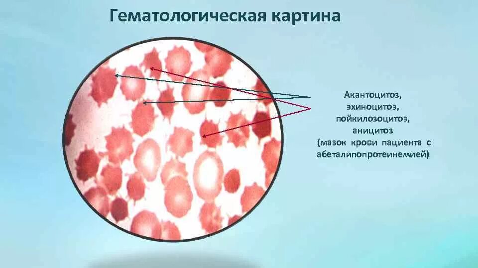 Наследственный акантоцитоз. Гематологическая картина. Акантоциты в мазке крови. Эхиноцитоз.