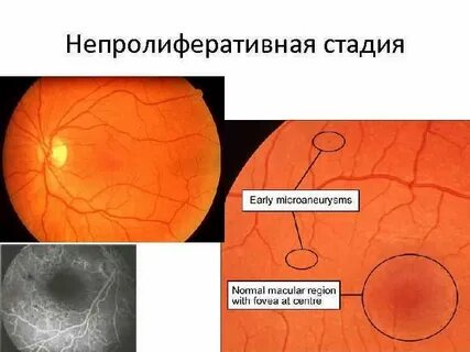 Диабетическая ретинопатия стадии