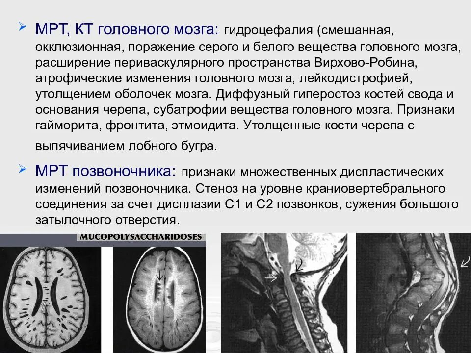 Поражение белого и серого вещества головного мозга. Поражение серого вещества головного мозга. Диффузный гиперостоз костей свода черепа. Диффузное поражение белого вещества головного мозга мрт. Поражение белого вещества мозга