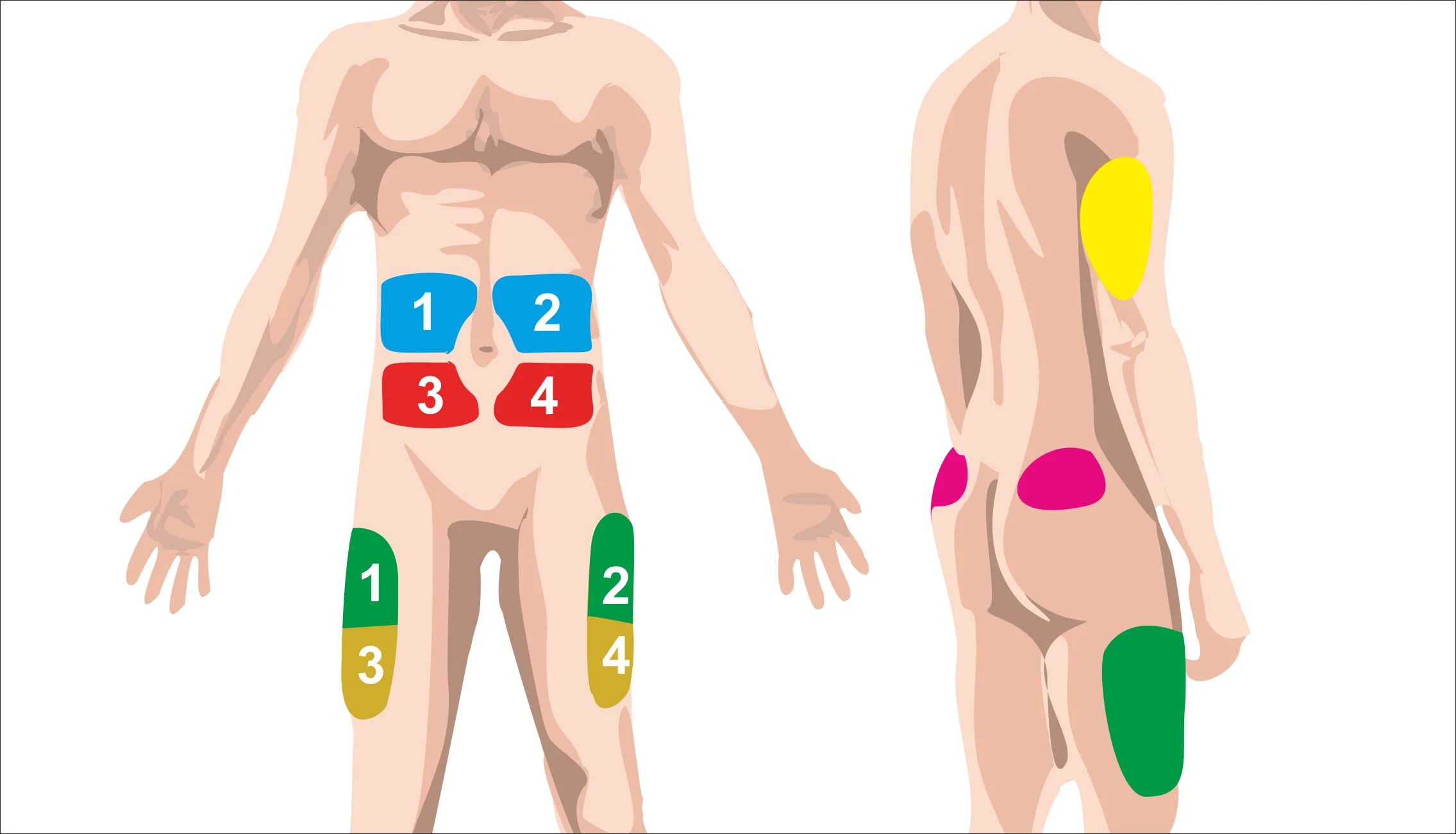 Зоны колоть инсулин. Зоны куда колоть инсулин. Места постановки инъекций инсулина. Зоны для внутримышечных инъекций в бедро. Место уколов в бедро