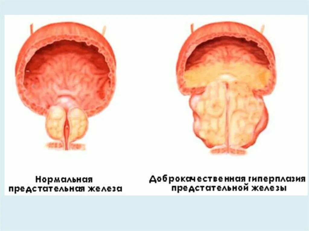 Простатит гиперплазия. Нодозная гиперплазия предстательной железы что это. Аденома предстательной железы и ДГПЖ. Доброкачественная Узловая гиперплазия предстательной железы. Доброкачественная гиперплазия предстательной железы (ДГПЖ).