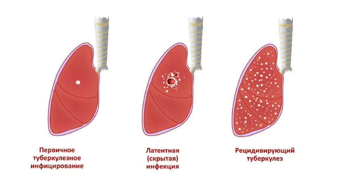 Фазы развития туберкулеза. Стадии развития туберкулеза. Стадии туберкулеза легких. Проявление туберкулеза.