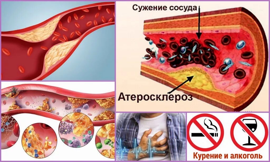 Лишний холестерин. Курение и атеросклероз сосудов. Атеросклероз сосудов факторы риска.