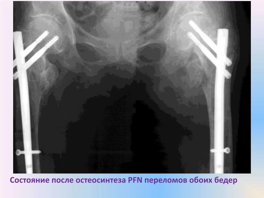 Операция остеосинтез шейки бедра. Перелом шейки бедра остеосинтез. Перелом шейки бедра остеосинтез рентген. Чрезвертельный перелом бедра остеосинтез. Интрамедуллярный остеосинтез биос.