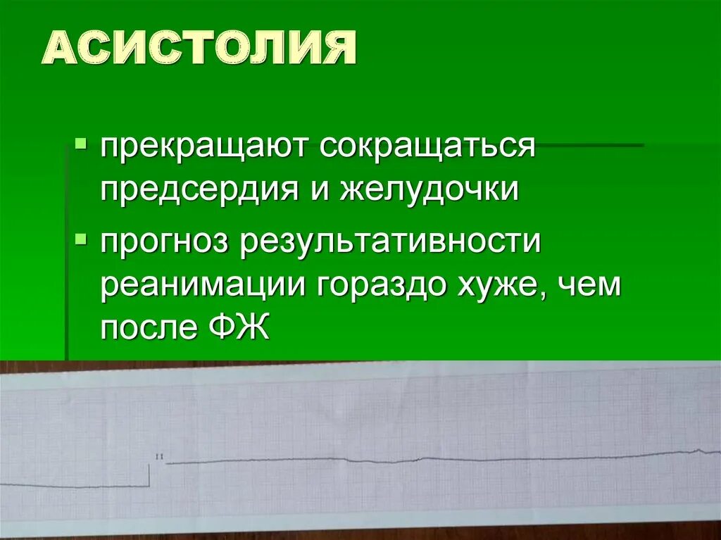 Асистолия. Асистолия причины. Асистолия желудочков на ЭКГ. Причины асистолии желудочков.