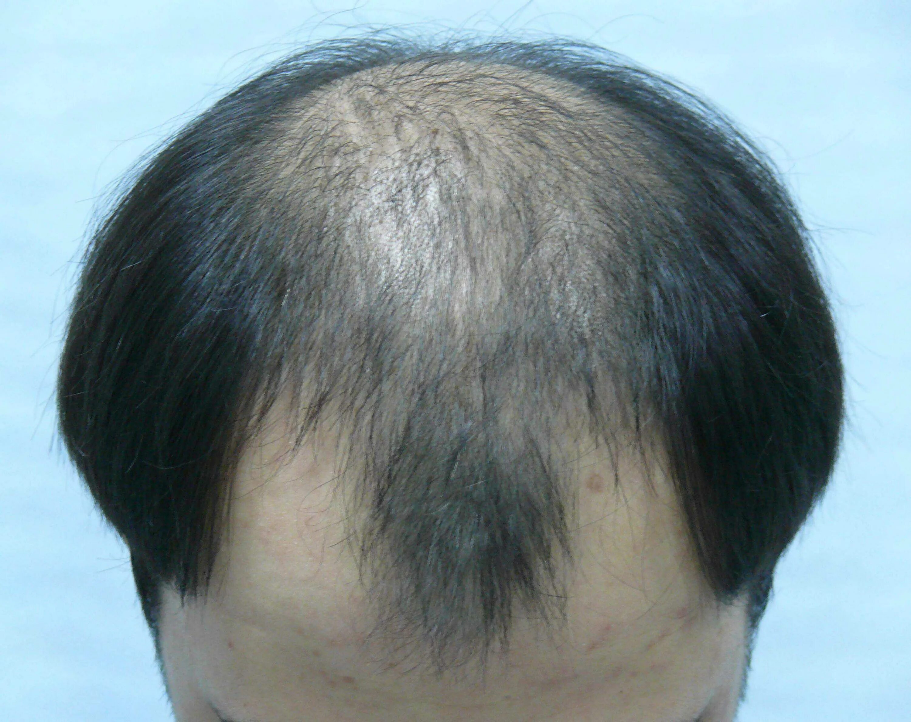 Андрогенетическая алопеция. Очаговая алопеция (alopecia Areata). Очаговая (гнездная) алопеция. После лучевой волосы выпадают