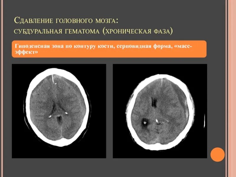 Компьютерная томография головного мозга гидроцефалия. Подострая ишемия головного мозга на кт. Гиподенсные очаги головного мозга. Гиподенсные очаги головного мозга. Глиоз головной мозг кт.